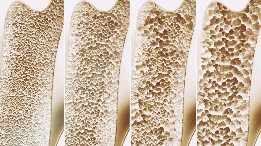 Reumatolog osteoporoza