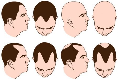 Etapy łysienia męskiego - zasady pielęgnacji włosów