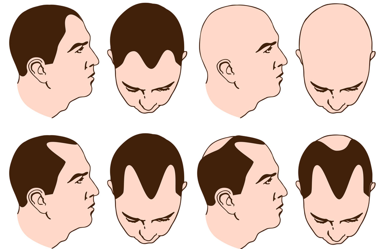Etapy łysienia męskiego - zasady pielęgnacji włosów