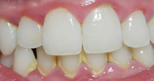 domowe wybielanie zębów