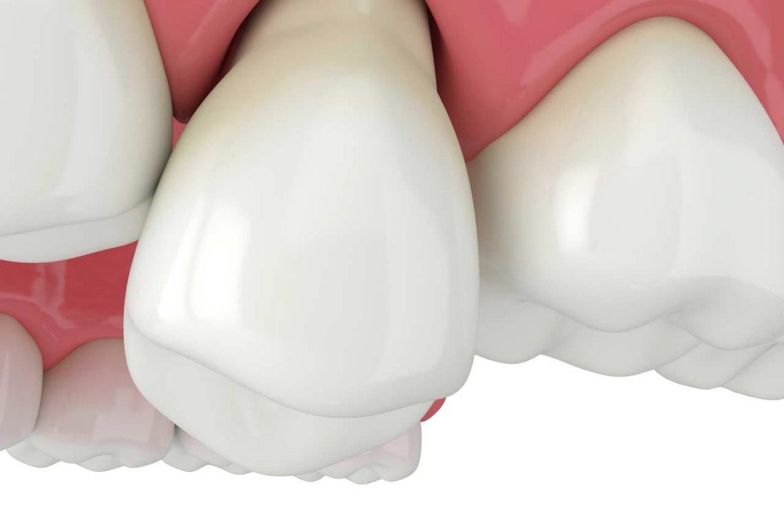 Odsłonięte szyjki zębowe